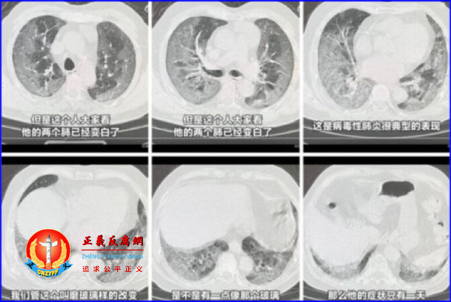3年前武汉疫情爆发时的典型症状“白肺”，近期似乎又开始在中国大量出现。.png