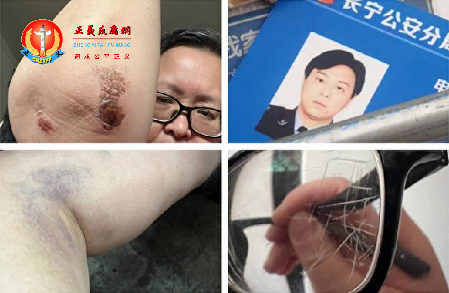 上海长宁区大金更小区61岁的周女士4月9日做核酸检测时被捅破咽喉部导致咽喉流血不止。她外出寻医时在小区内被警察殴打。.png